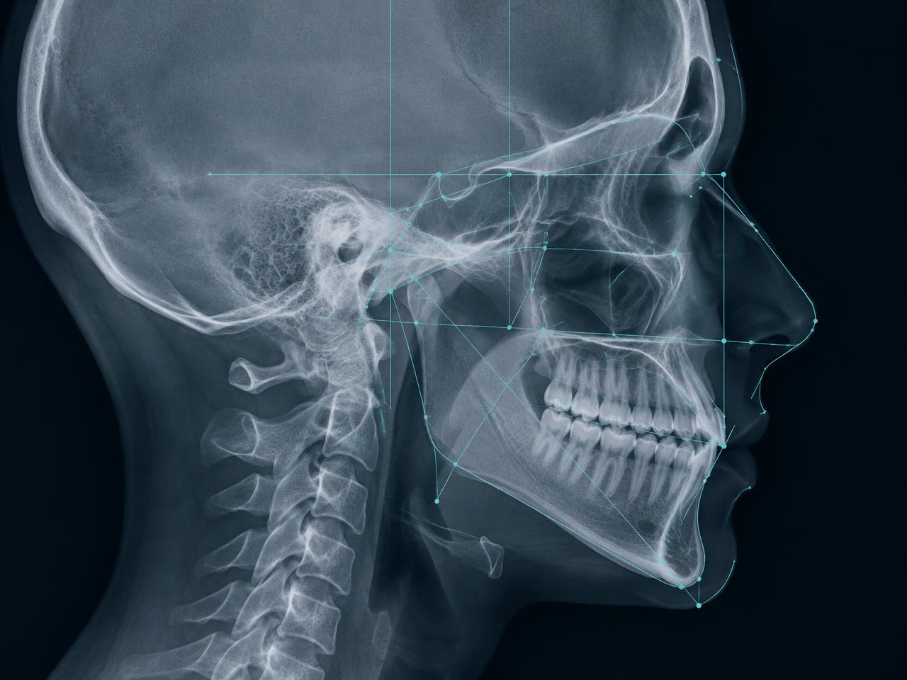 Illustrative lateral cephalometric radiograph with tracing lines