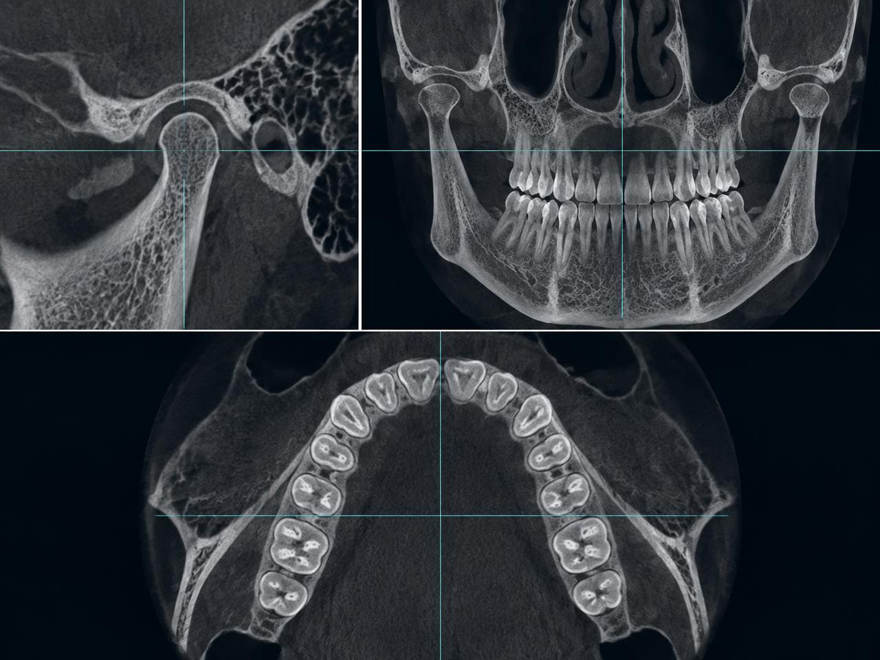 Illustrative TMJ and dental occlusion CBCT reformats in multiple views